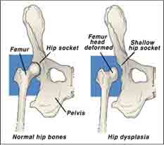 HIP DISPLAYSIA