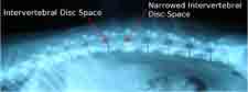 intervertebral